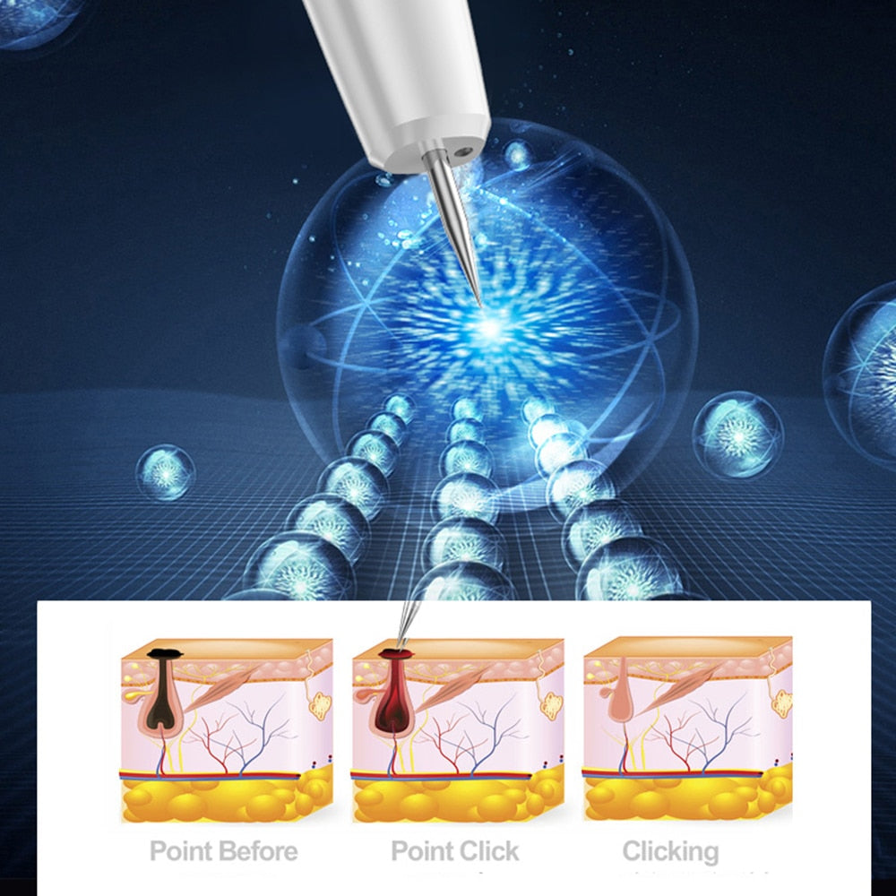 Laser Plasma Pen Skin Tag Remover